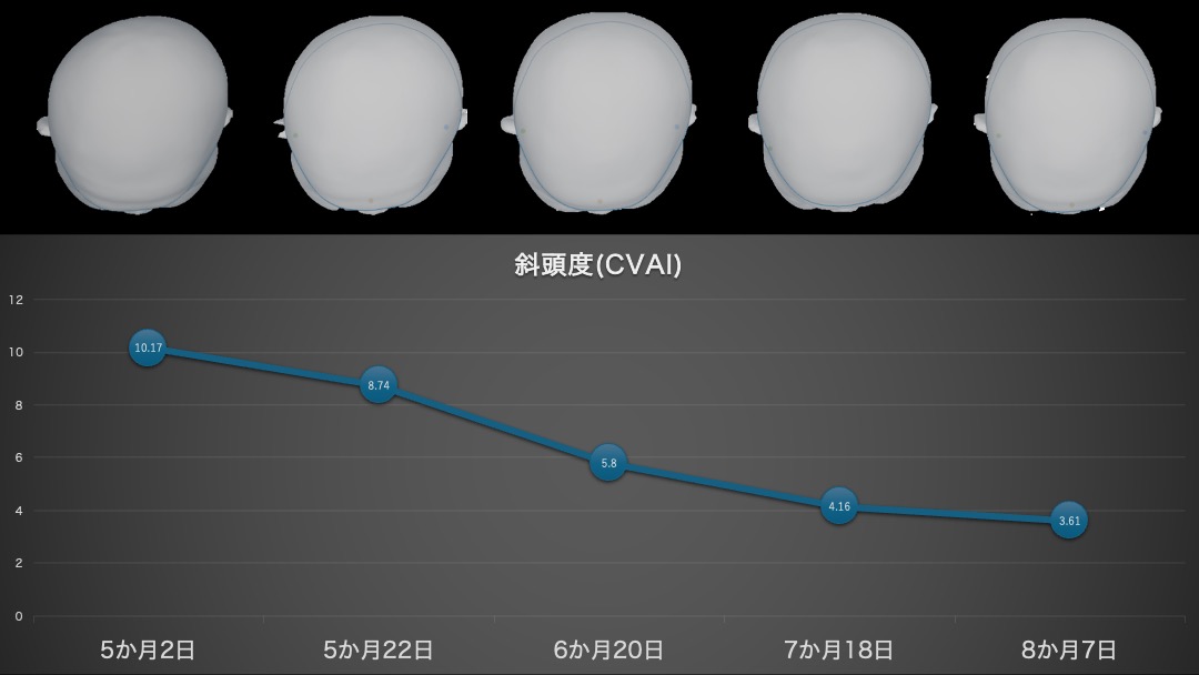 斜頭症治療例